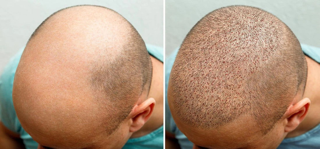 Is it Safe to Use Hair Concealers or Hair Fibers 4 Weeks After DHI Transplant?