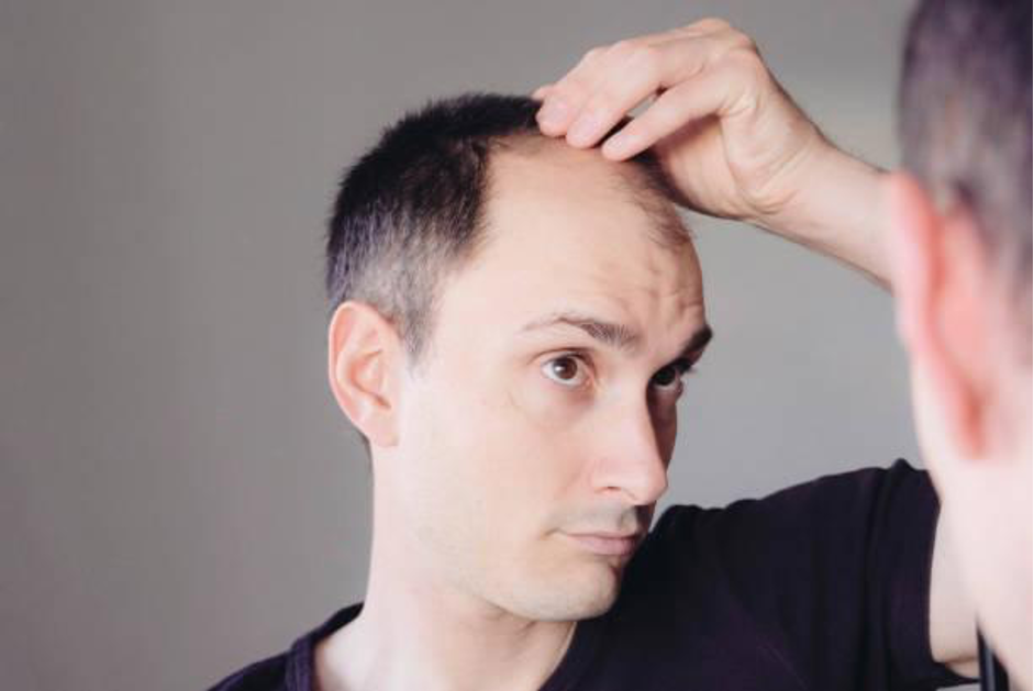 Can Vitamin D Deficiency Cause Hair Thinning