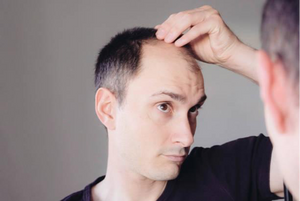 Can Vitamin D Deficiency Cause Hair Thinning
